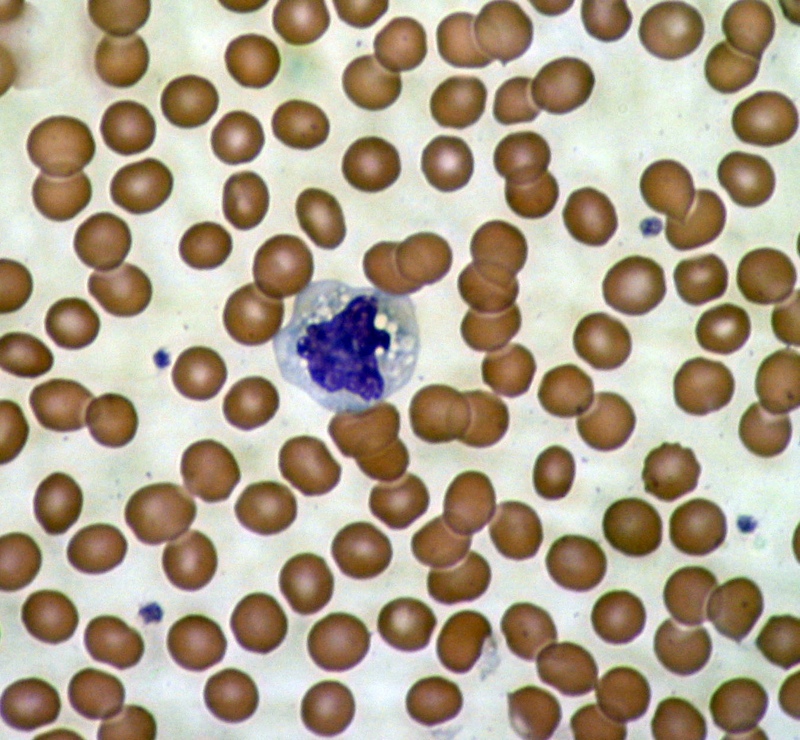 Hallazgos reveladores en células sanguíneas de pacientes con la enfermedad de Huntington