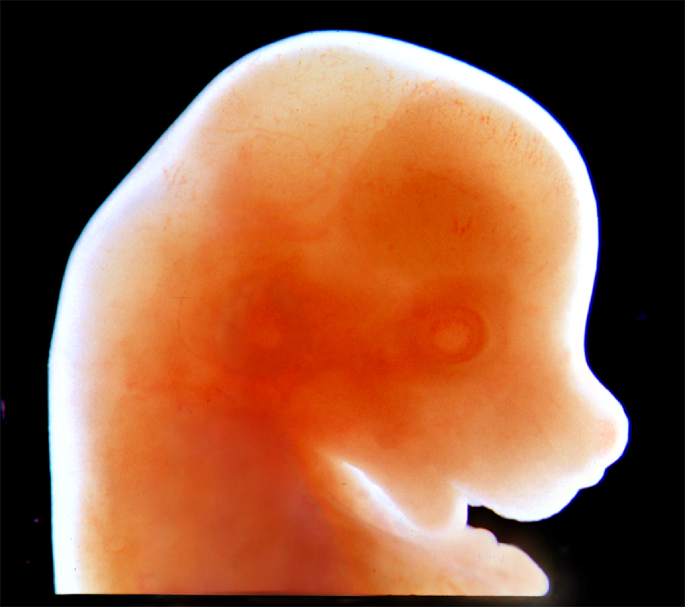 La exposición temprana a la proteína de la EH puede causar síntomas de por vida