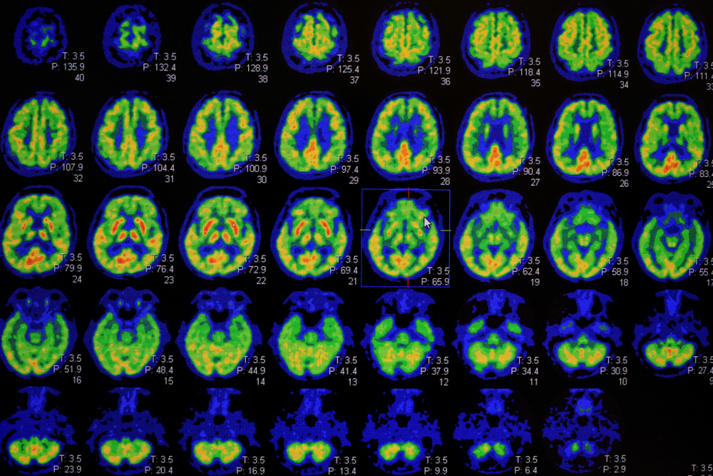 Cuando se rompe el reloj cerebral: Alteración del sueño y caos circadiano en la enfermedad de Huntington