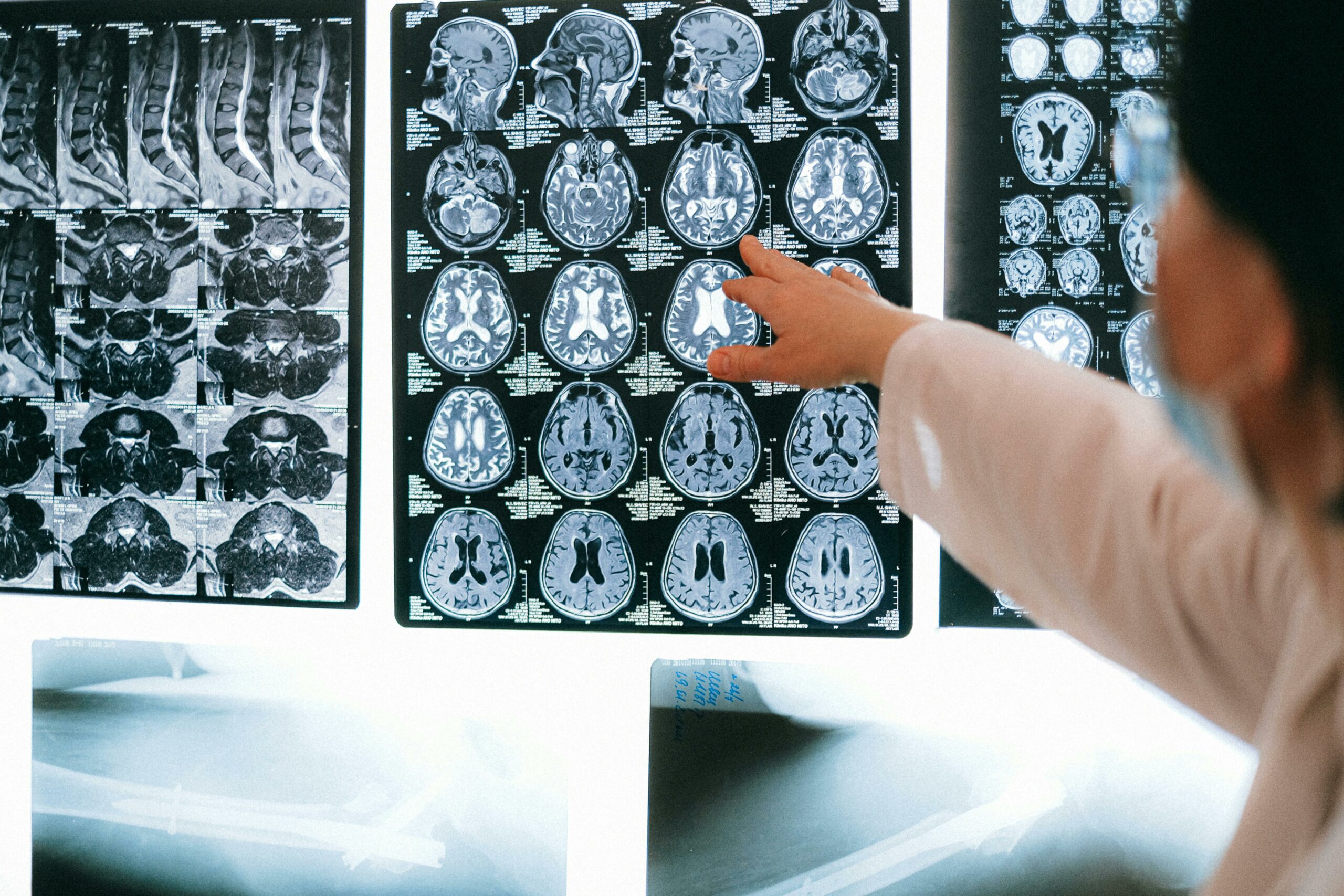 Premio HDBuzz 2025: RM-«¿por qué» me siento así? Cómo la resonancia magnética nos ayuda a entender por qué las personas con EH a veces no son conscientes de sus síntomas